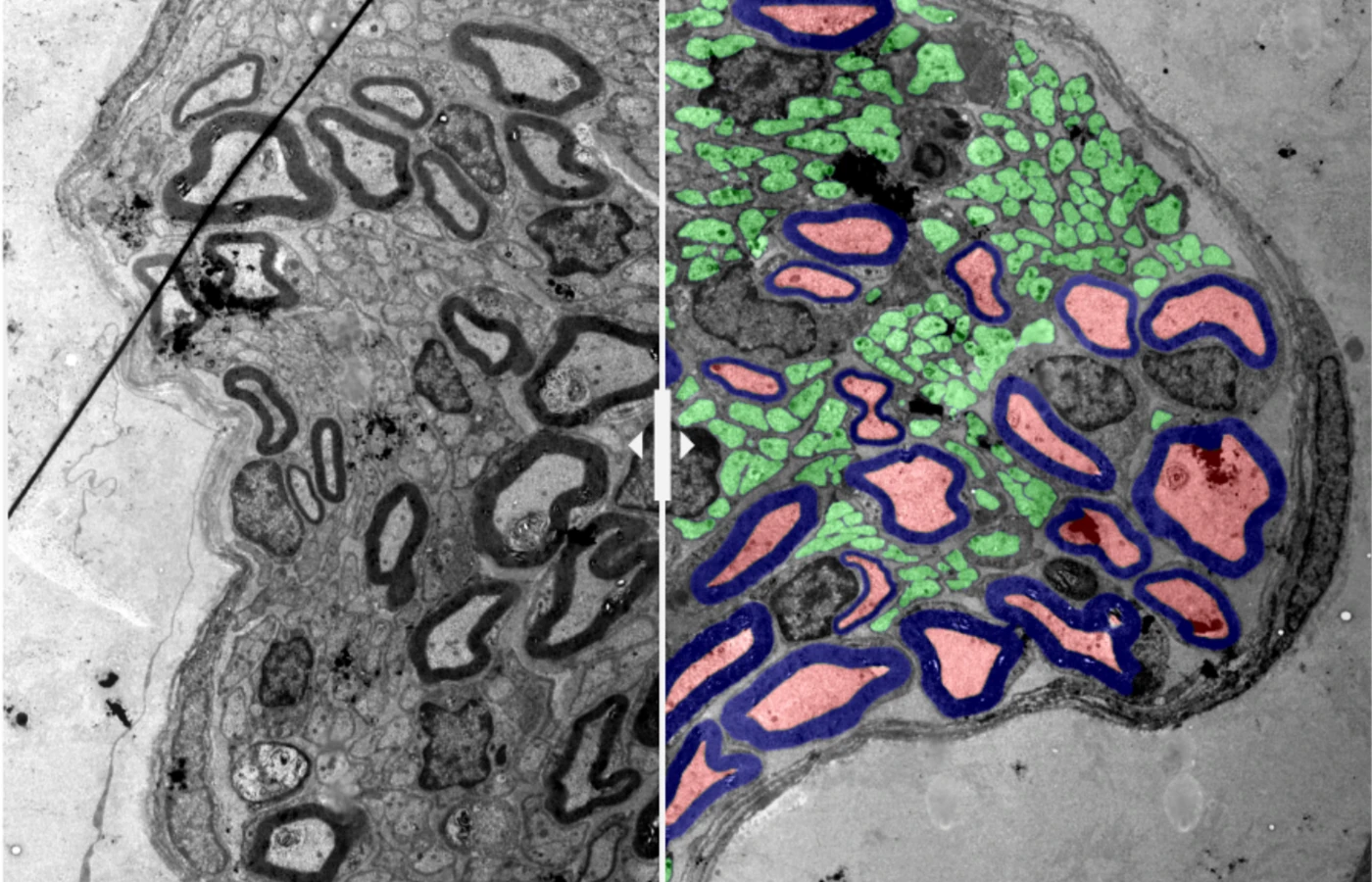 Electron micrograph of a peripheral nerve before and after automated axon segmentation